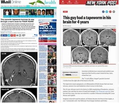 4年悩んだ頭痛の原因は寄生虫、記憶障害や嗅覚への影響にも苦しむ。