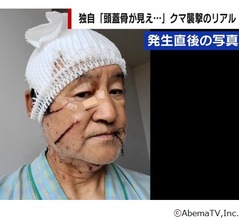 クマに襲われた男性「鏡見たら頭蓋骨開いていた」額噛まれ皮持っていかれる