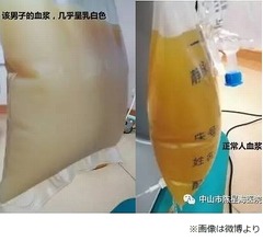 &ldquo;採血したら牛乳のような液体&rdquo;驚きの声も