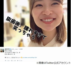 指原莉乃、腫れすぎて顔の形変わる