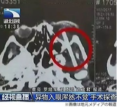 「目が変だな&hellip;」1週間前から箸が刺さっていた