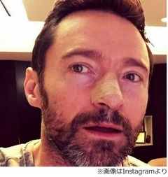 ヒュー・ジャックマンの皮膚がん再発、日焼け止め使用や定期検診呼びかけ。