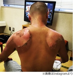 あばれる君の痛々しい日焼け、背中の皮が激しくむけた姿に心配の声。