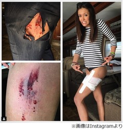女優が映画撮影でのケガ公開、自らスタントに取り組んでいる&ldquo;証拠&rdquo;。