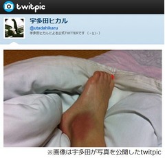 宇多田が1人お遍路で靱帯損傷「骨は大丈夫だったけど靭帯傷んでる」。