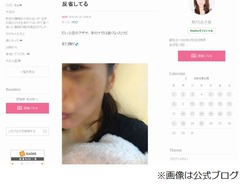 熊切あさ美の顔に大きなあざ「久しぶりに派手に転んじゃった」。