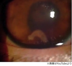 恐怖&hellip;目の中を泳ぐ寄生虫