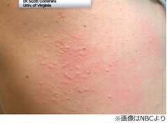 ダニに刺されて肉アレルギーに、食後に発疹発症例など米国で増加。