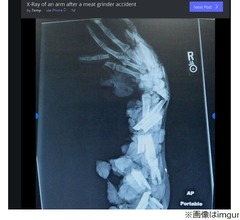挽肉機に巻き込まれた腕のレントゲンが話題