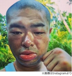 あばれる君の顔が大変な事に、唇腫れ上がり「海外の蚊はクレイジー」。