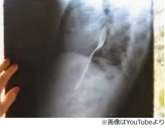 友人と賭けでフォーク飲み込む、勝負には勝つも体内から取り出せず。