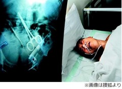 謎の&ldquo;30年間の胃痛&rdquo;原因判明、胃潰瘍手術時に鉗子置き忘れる。