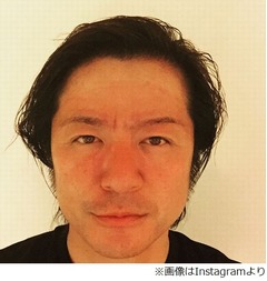 GLAY・TERUの顔が「ヤバイ&hellip;」、数日後に撮影も「焼けすぎた（笑）」。