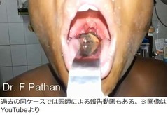 のどへ魚が飛び込み死の危機、16歳が口に挟んでいたらひゅるっと。