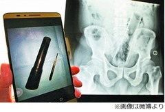 肛門に&ldquo;懐中電灯&rdquo;挿入の悲劇、カラオケでケンカ相手に無理矢理&hellip;。