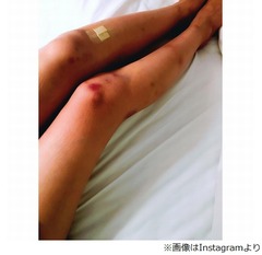 有村架純&ldquo;傷だらけの脚&rdquo;に反響