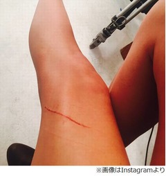 &ldquo;48億円の美脚&rdquo;に大きな傷、テイラー・スウィフトがInstagramに写真。