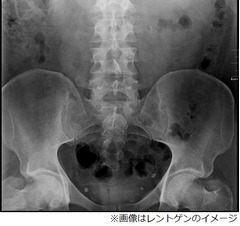 手術で&ldquo;健康な睾丸&rdquo;を誤摘出、「父親になれない」と病院を提訴。