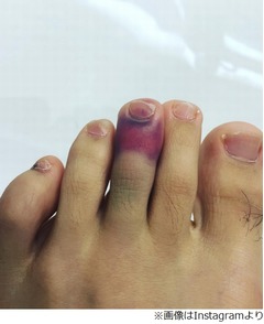 三浦翔平が足に痛々しいけが、左足中指変色でファンから心配の声殺到。
