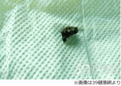 鼻血の原因は&ldquo;乳歯&rdquo;だった、幼少の頃に抜け落ちたあと鼻腔へ侵入。