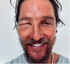  マシュー・マコノヒー、ハチに刺され目腫れ上がるも&ldquo;にっこり&rdquo;