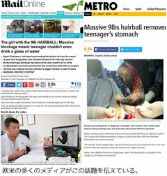 胃の中から4kgの巨大毛玉摘出、髪の毛やカーペットを食べ続けた少女。