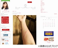 ミキティのやけどに心配の声、右腕に「急いでたらフライパンで」。