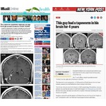 4年悩んだ頭痛の原因は寄生虫、記憶障害や嗅覚への影響にも苦しむ。