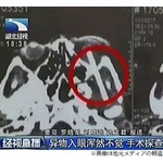 「目が変だな&hellip;」1週間前から箸が刺さっていた