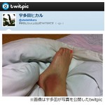 宇多田が1人お遍路で靱帯損傷「骨は大丈夫だったけど靭帯傷んでる」。