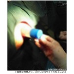 肛門に&ldquo;液体のり&rdquo;挿入し抜けず、医師「のりが漏れなくて良かった」。