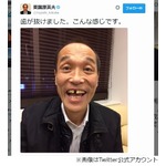 東国原英夫氏の前歯が抜けた、講演中に差し歯取れ「会場大爆笑」。