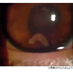 恐怖&hellip;目の中を泳ぐ寄生虫