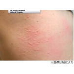 ダニに刺されて肉アレルギーに、食後に発疹発症例など米国で増加。