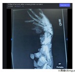 挽肉機に巻き込まれた腕のレントゲンが話題