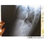 友人と賭けでフォーク飲み込む、勝負には勝つも体内から取り出せず。