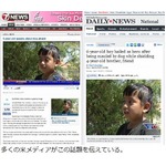 6歳が自分を&ldquo;盾&rdquo;にして弟ら守る、犬の襲撃受け「腕や肩、頭噛まれた」。