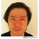 GLAY・TERUの顔が「ヤバイ&hellip;」、数日後に撮影も「焼けすぎた（笑）」。