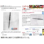 肺の中から錆びた刺しゅう針、20数年間も気が付かなかった中国の男性。