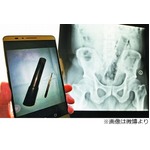 肛門に&ldquo;懐中電灯&rdquo;挿入の悲劇、カラオケでケンカ相手に無理矢理&hellip;。