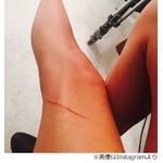 &ldquo;48億円の美脚&rdquo;に大きな傷、テイラー・スウィフトがInstagramに写真。