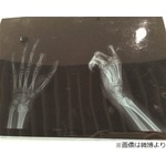 ゲーム叱られた少年が指を切断、&ldquo;遊び過ぎ&rdquo;注意され逆上&rarr;自ら&hellip;。