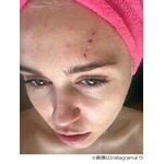 猫がマイリー・サイラスを襲撃、引っかかれた痛々しい傷跡を公開。