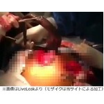 腸から生きた&ldquo;巨大魚&rdquo;を摘出、肛門から侵入報道も男性は口をつぐむ。
