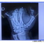 &ldquo;爆竹遊び&rdquo;で少年の指4本吹っ飛ぶ