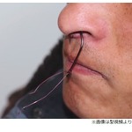 魚釣りで&ldquo;自分が釣れた&rdquo;、釣り針が鼻貫通