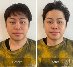 ノンスタ井上“顔の美容施術”のビフォーアフター公開、「すごい！顔が違う…」と反響