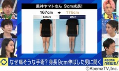 “骨延長手術”で身長9cm伸ばした男性、人生変わった？