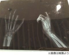 ゲーム叱られた少年が指を切断、“遊び過ぎ”注意され逆上→自ら…。