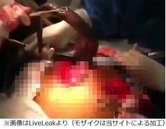腸から生きた“巨大魚”を摘出、肛門から侵入報道も男性は口をつぐむ。